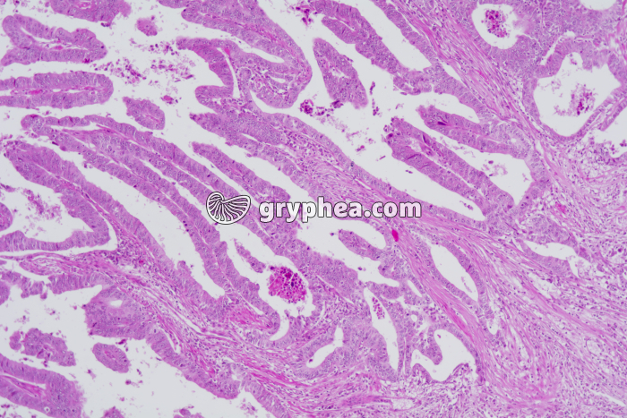 Cancer de la vésicule biliaire x25 - gryphea.org